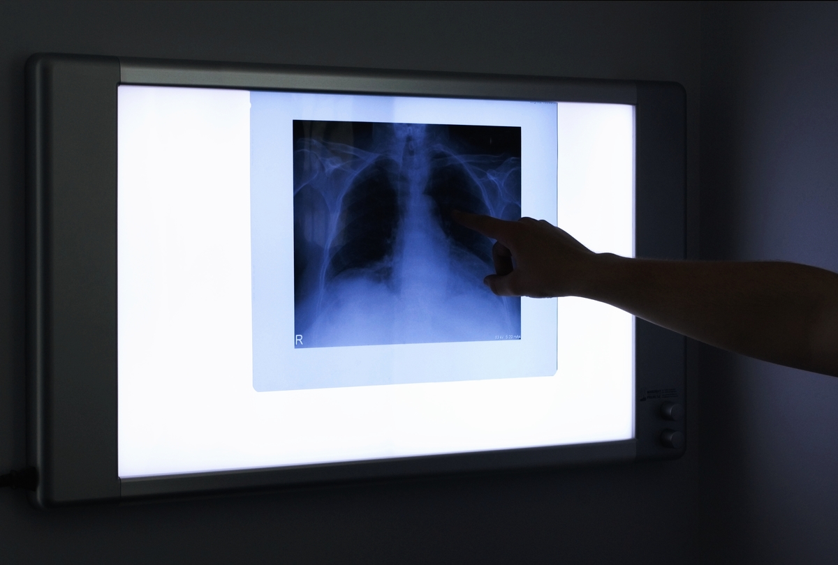 x-ray - 129375686 X-ray of patients chest is being reviewed on an illuminated wall-mounted monitoring screen.