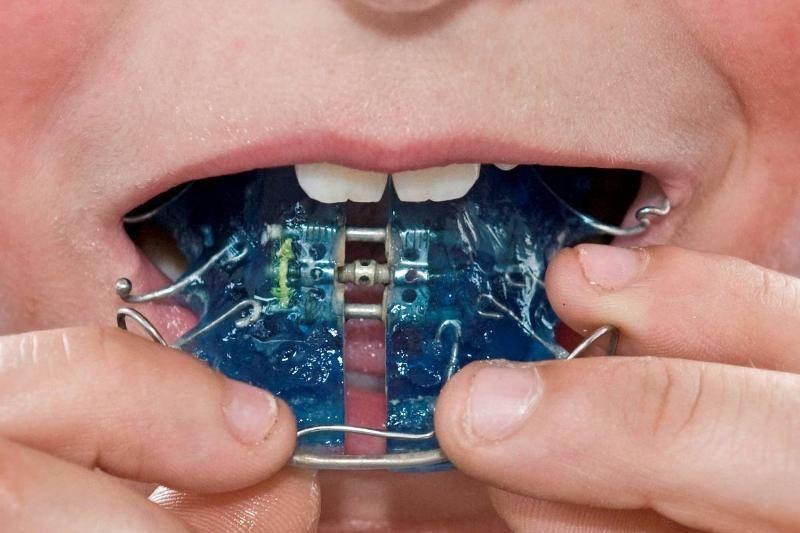 boy-putting-on-orthodontic-braces.-91723 boy-putting-on-orthodontic-braces.-91723