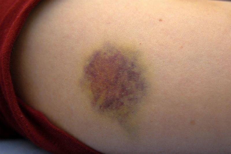 bruise bruise