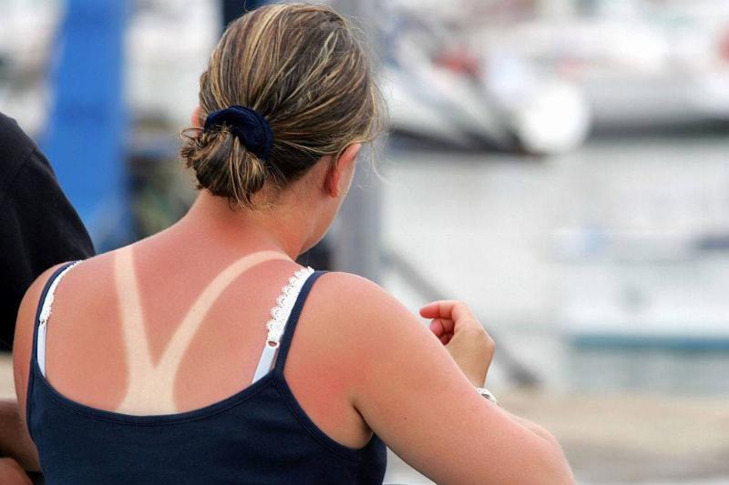 sunburn sunburn