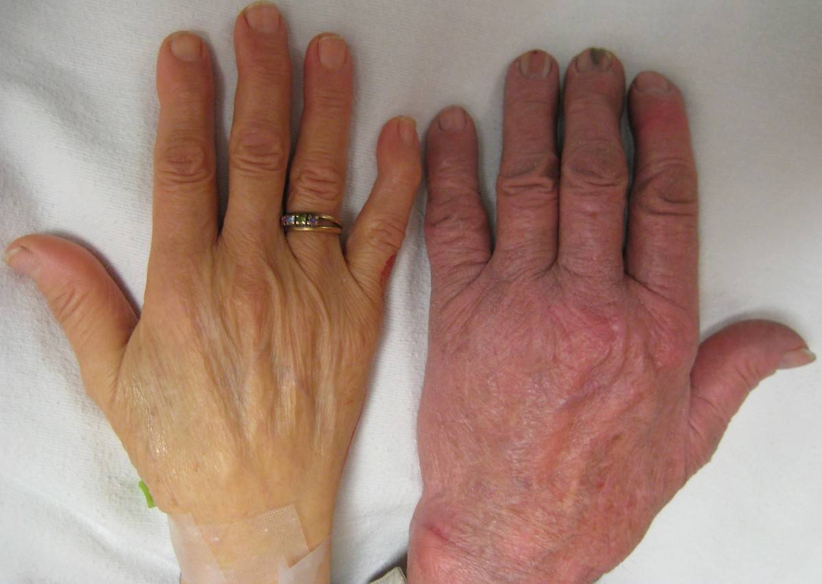 Anemic hands (left) next to normal hands (right)