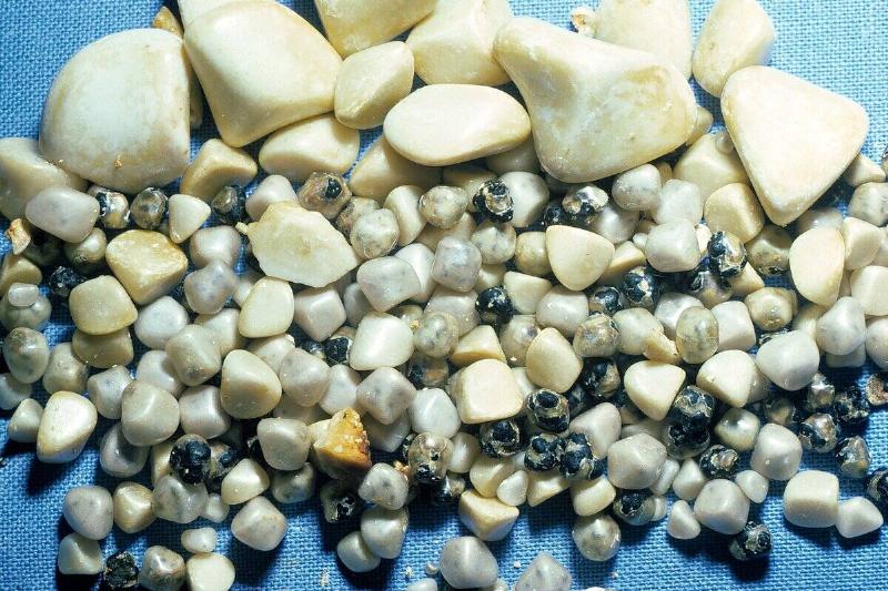 Gallstones