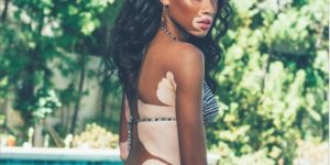 Winnie Harlow, the vitiligo model.