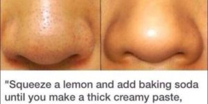 How to remove blackheads.