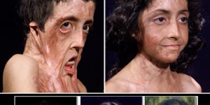 A burn victim gets facial reconstruction.
