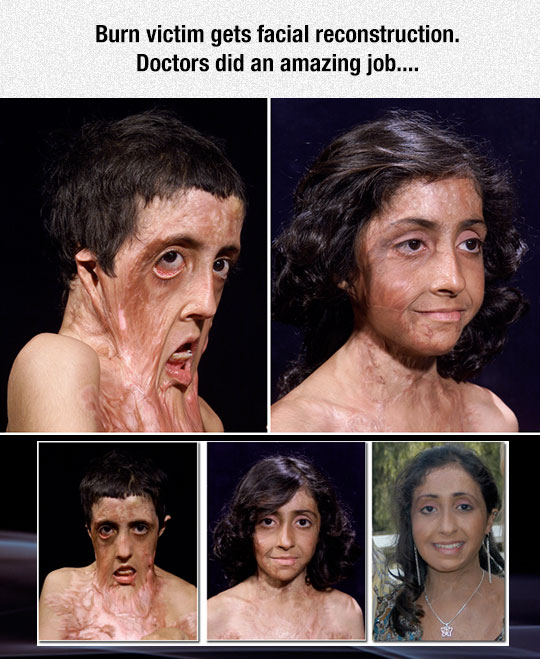 A burn victim gets facial reconstruction.