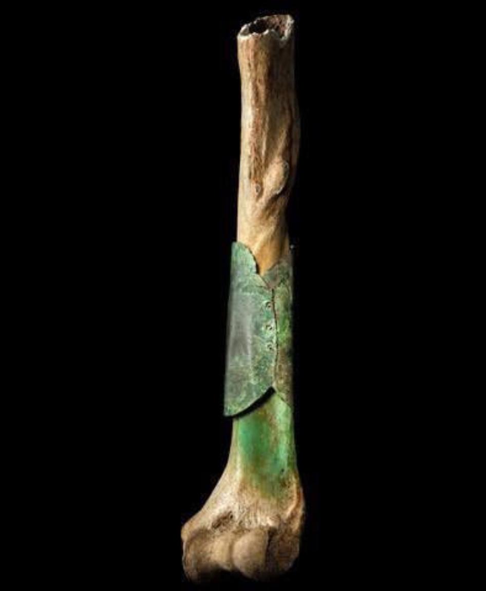 A medieval surgeon repaired bone with riveted copper.