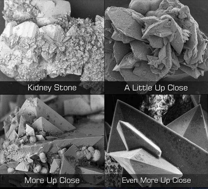 Kidney stones of death