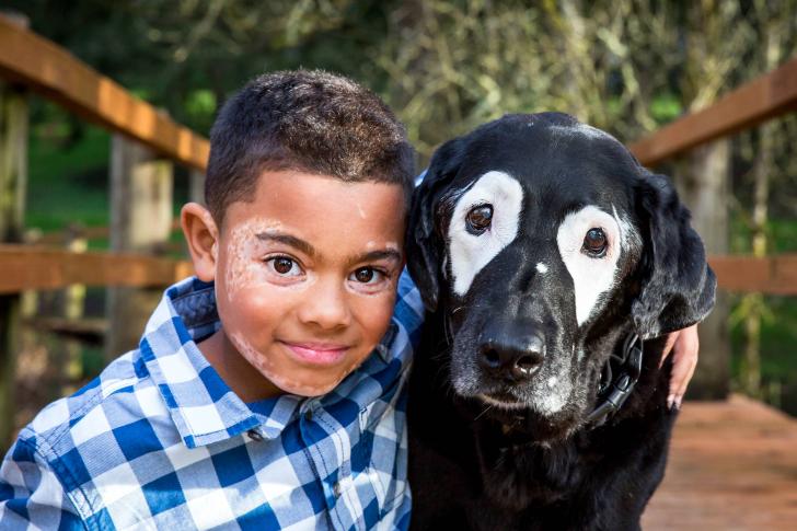 8-Year-Old Boy Embarrassed Of Vitiligo Meets Dog With Same Skin Condition