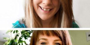 The difference braces can make