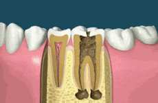 Ever Seen A Root Canal Surgery?