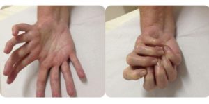 A rare Laurin Sandrow syndrome causes mirroring of hands