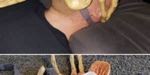 Turning your sleep apnea machine into Alien facehugger. Science has come so far…