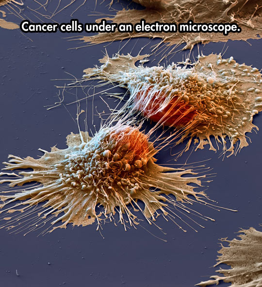 Cancer cells under an electron microscope.