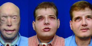 Patrick Hardison, the recipient of the most extensive facial transplant surgery to date, before his transplant, immediately after, and one year later.