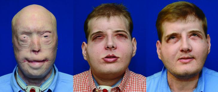 Patrick Hardison, the recipient of the most extensive facial transplant surgery to date, before his transplant, immediately after, and one year later.