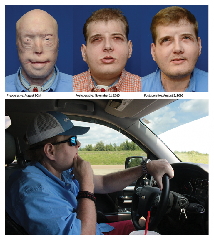 Face transplant recipient one year later.