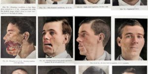 WW1 facial reconstruction, circa 1916.
