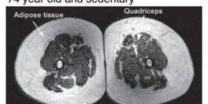 MRI cross sections of leg muscles show the consequences of various lifestyle choices.