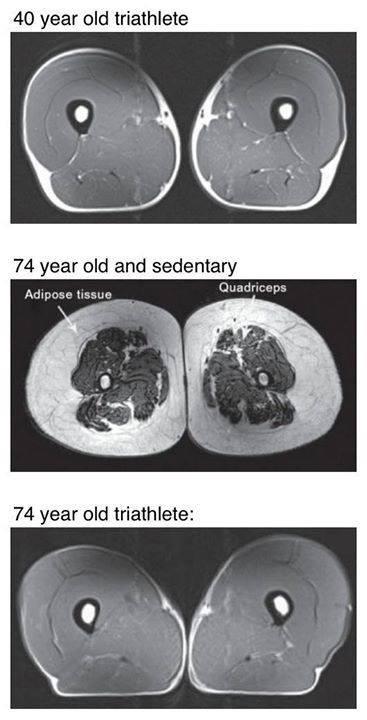 MRI cross sections of leg muscles show the consequences of various lifestyle choices.