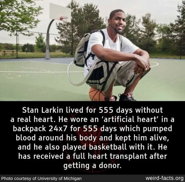 he lived over a year without a heart