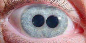 The Pupula duplex is a medical oddity that is characterized by having two irises