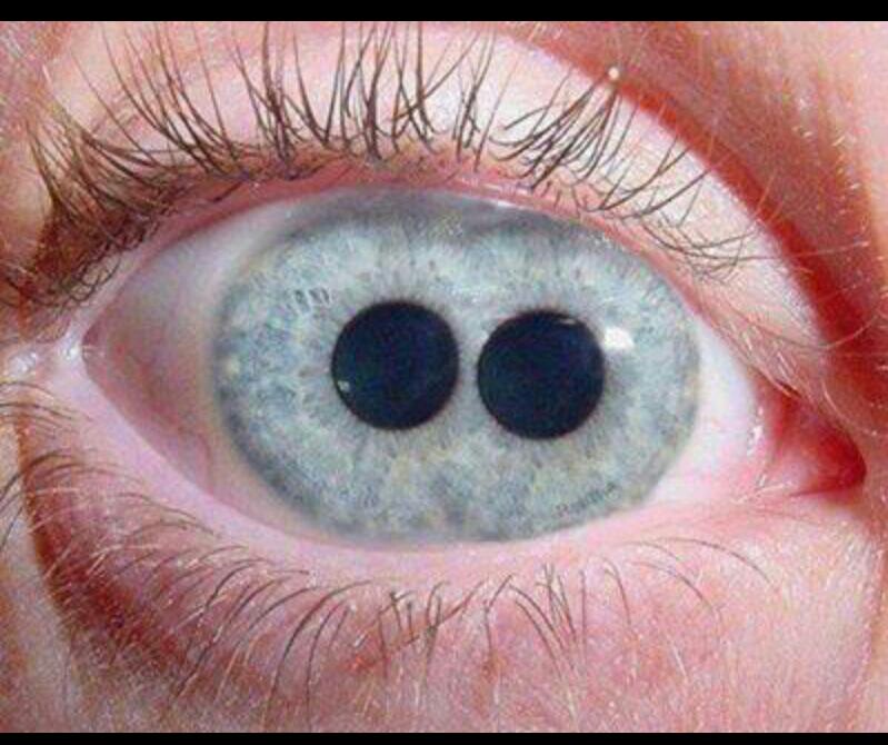 The Pupula duplex is a medical oddity that is characterized by having two irises